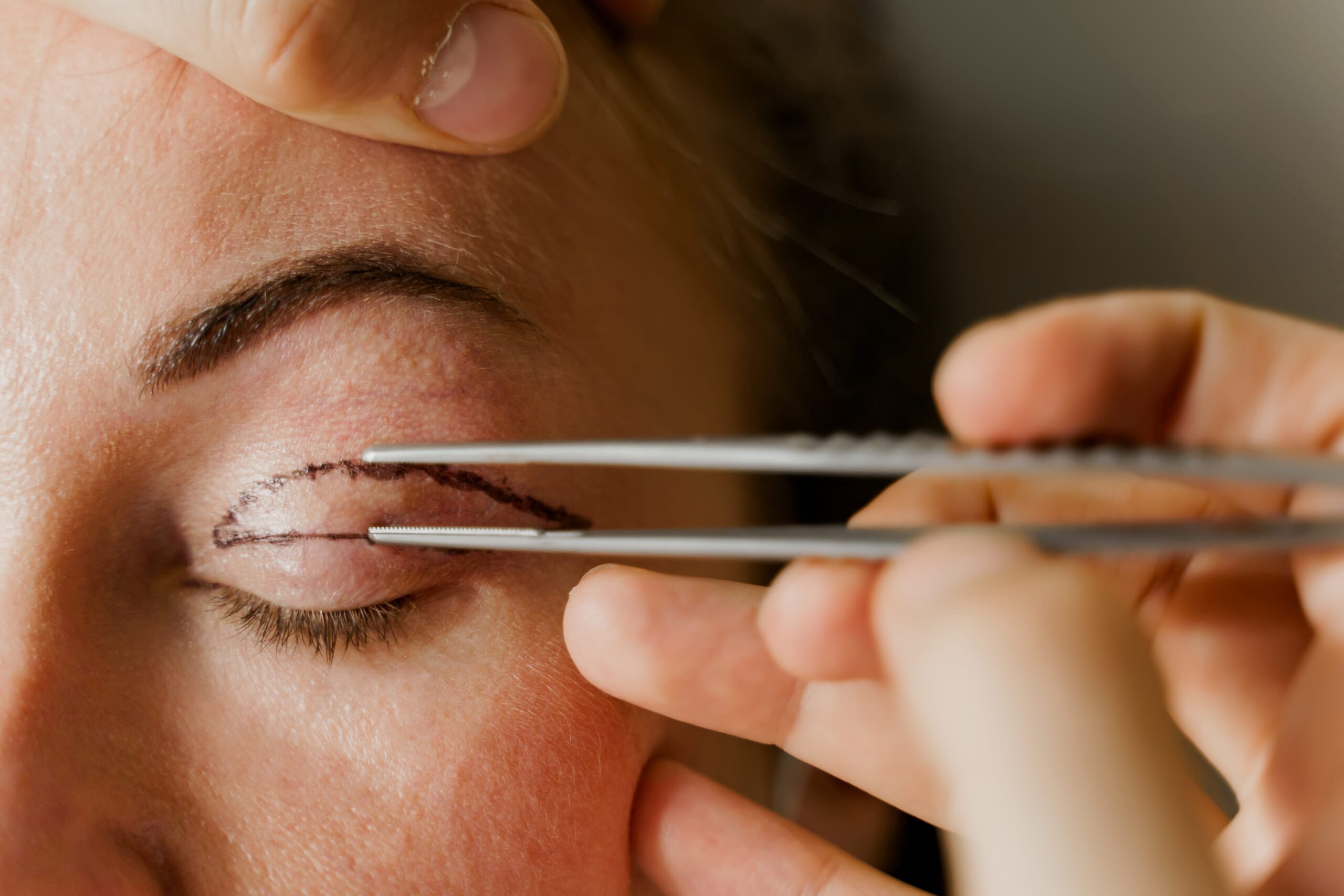 Surgeon marking woman's eyelid for blepharoplasty procedure