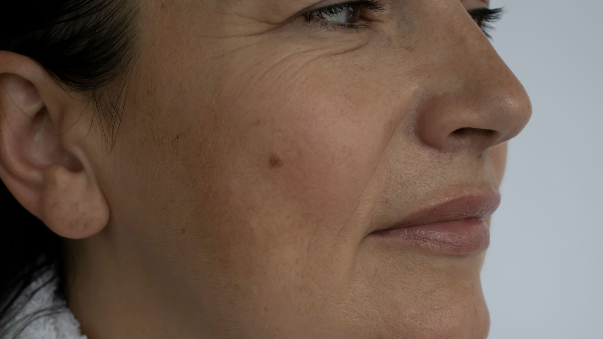 woman face wrinkles before and after treatment