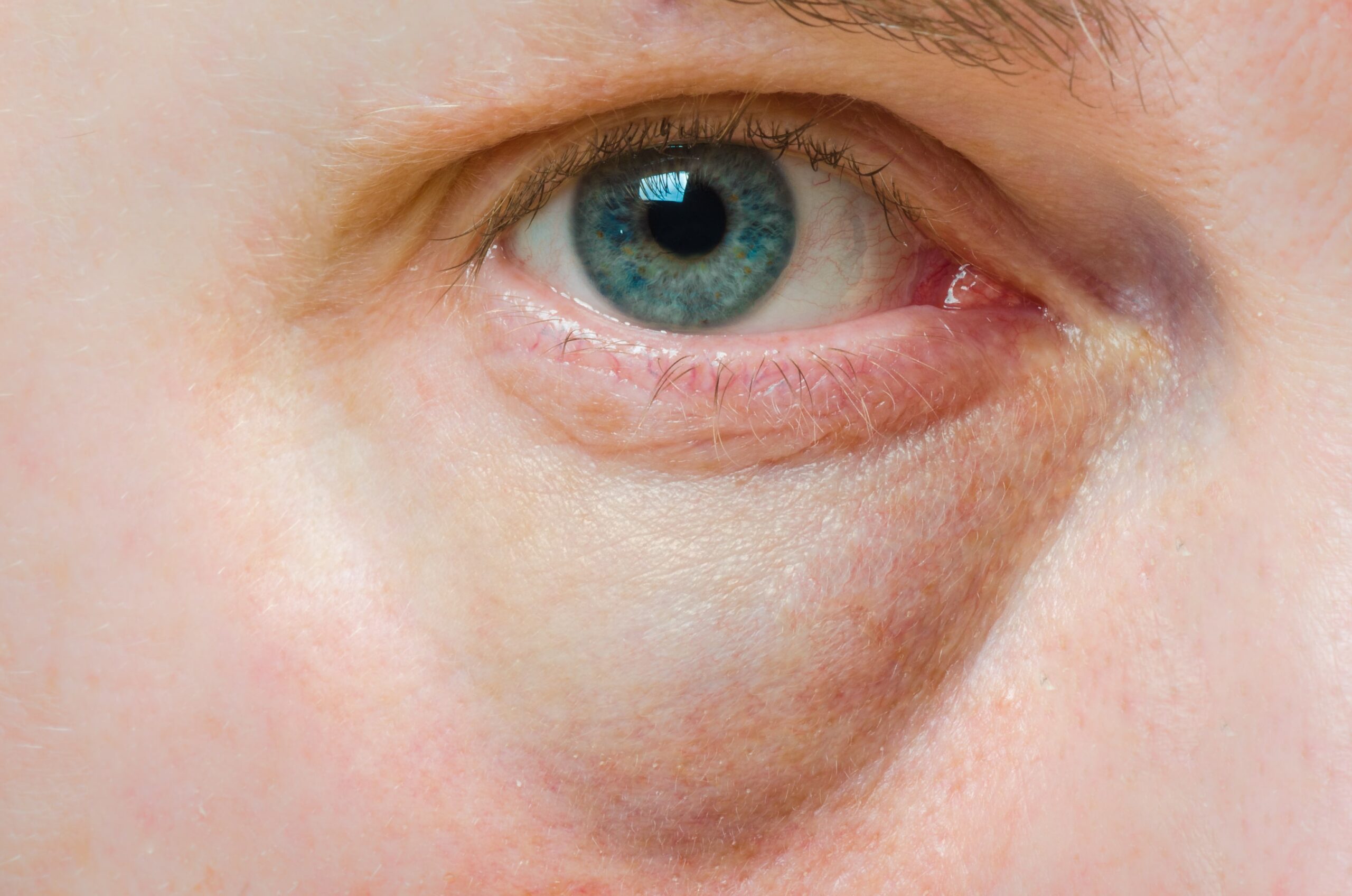 Close-up of eye showing upper eyelid and lower eyelid with visible under-eye bag