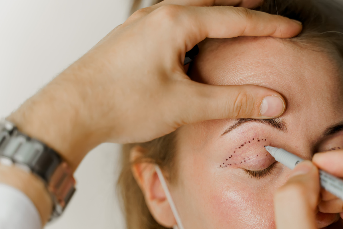 Surgeon precisely marking patient's upper eyelid in preparation for blepharoplasty procedure