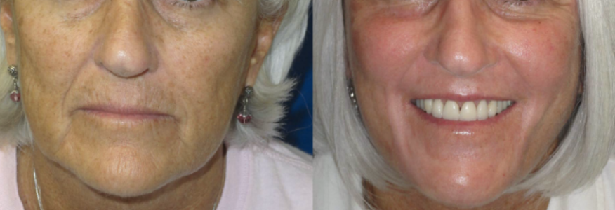 laser-skin-resurfacing-62-woman-1.png