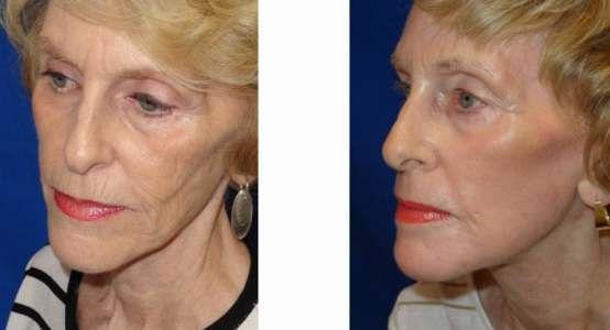 laser-skin-resurfacing-before-and-after-woman-over-50-1.png